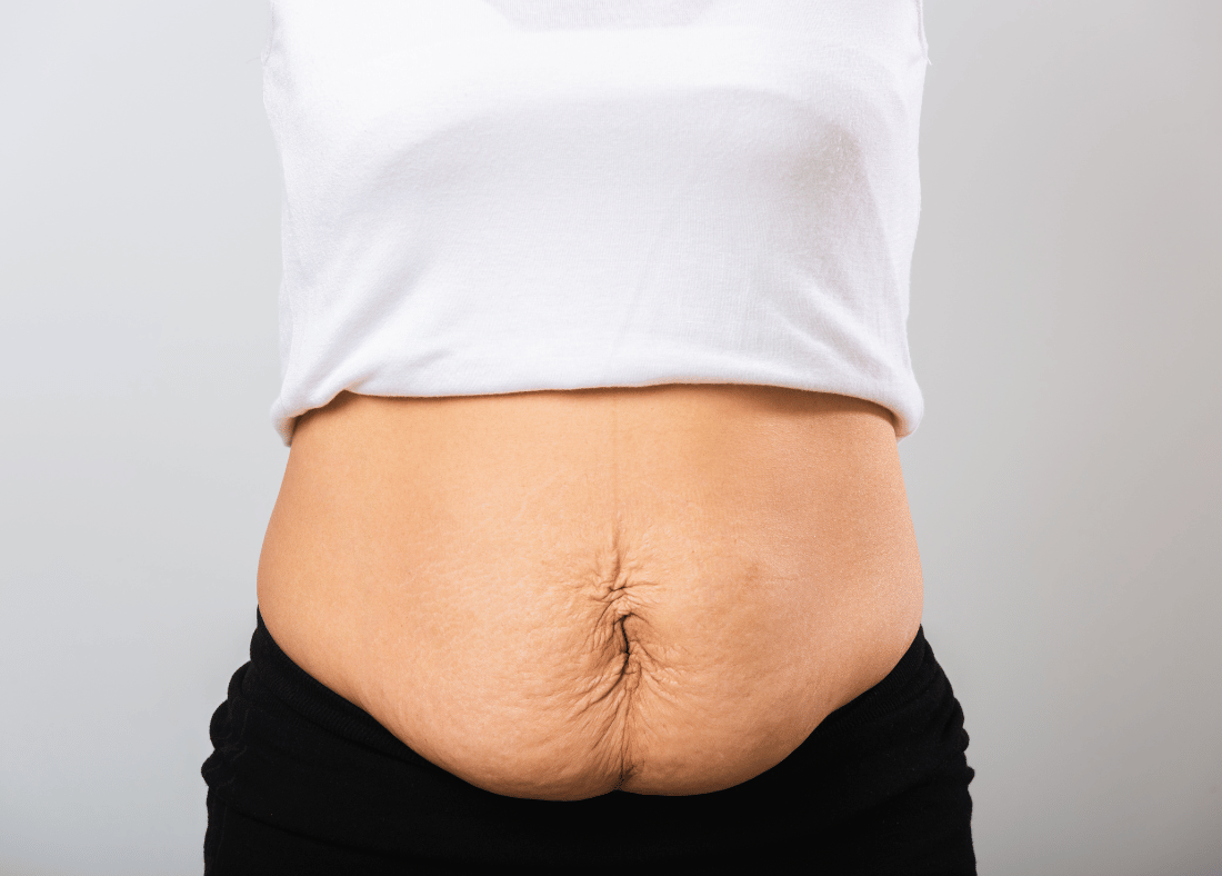 loose tummy skin